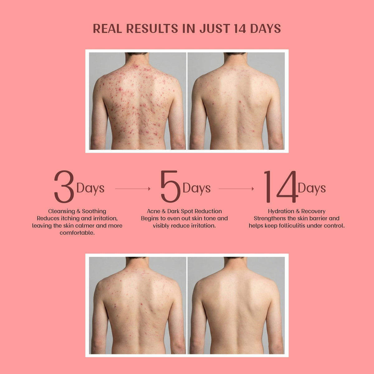 Image 7 of Velleja Exfoliating Body Wash with Salicylic Acid for Body Acne & Rough Bumpy Skin | Reduce Strawberry Legs