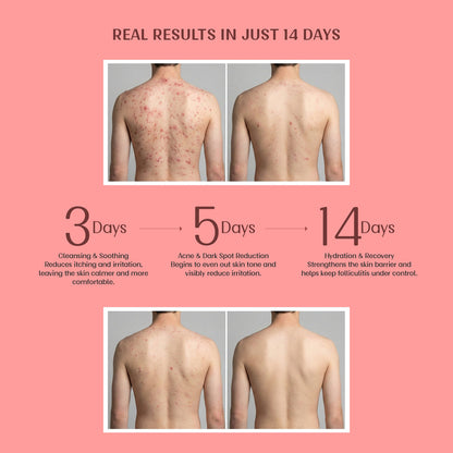Image 7 of Velleja Exfoliating Body Wash with Salicylic Acid for Body Acne & Rough Bumpy Skin | Reduce Strawberry Legs