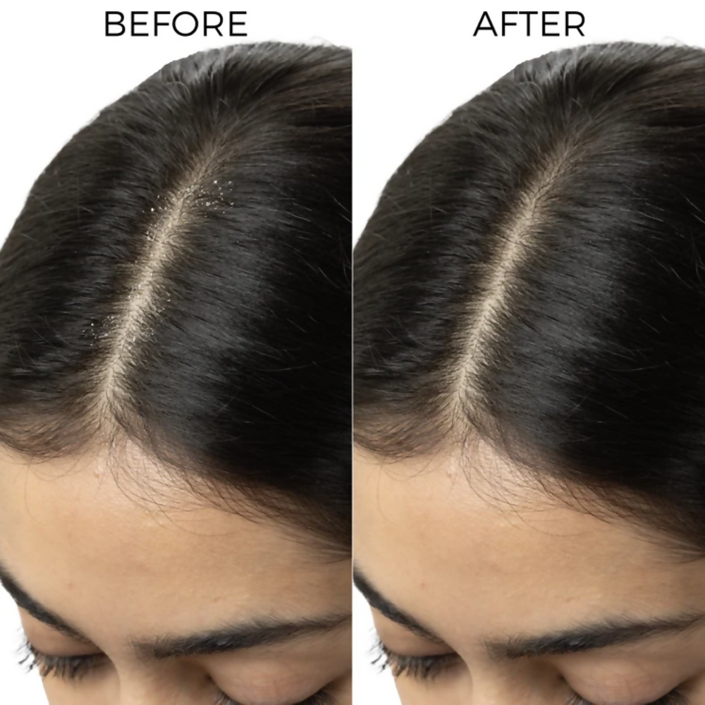 Image 6 of Brillare Dandruff Control Kit
