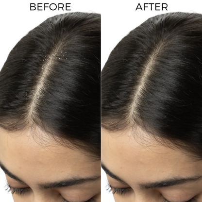 Image 6 of Brillare Dandruff Control Kit