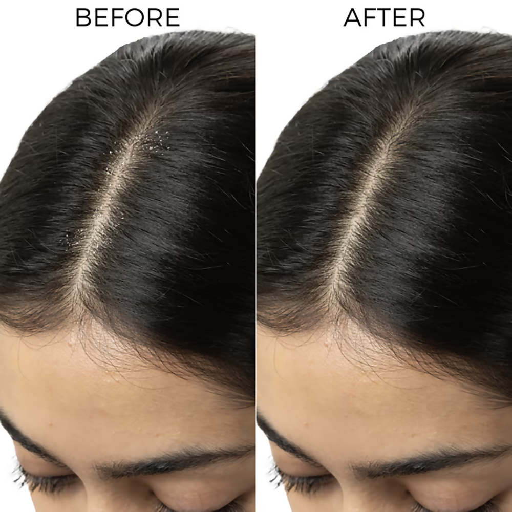 Image 4 of Brillare Tea Tree & Salicylic Oil Shots For Dandruff Control