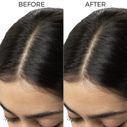 Image 4 of Brillare Tea Tree & Salicylic Oil Shots For Dandruff Control