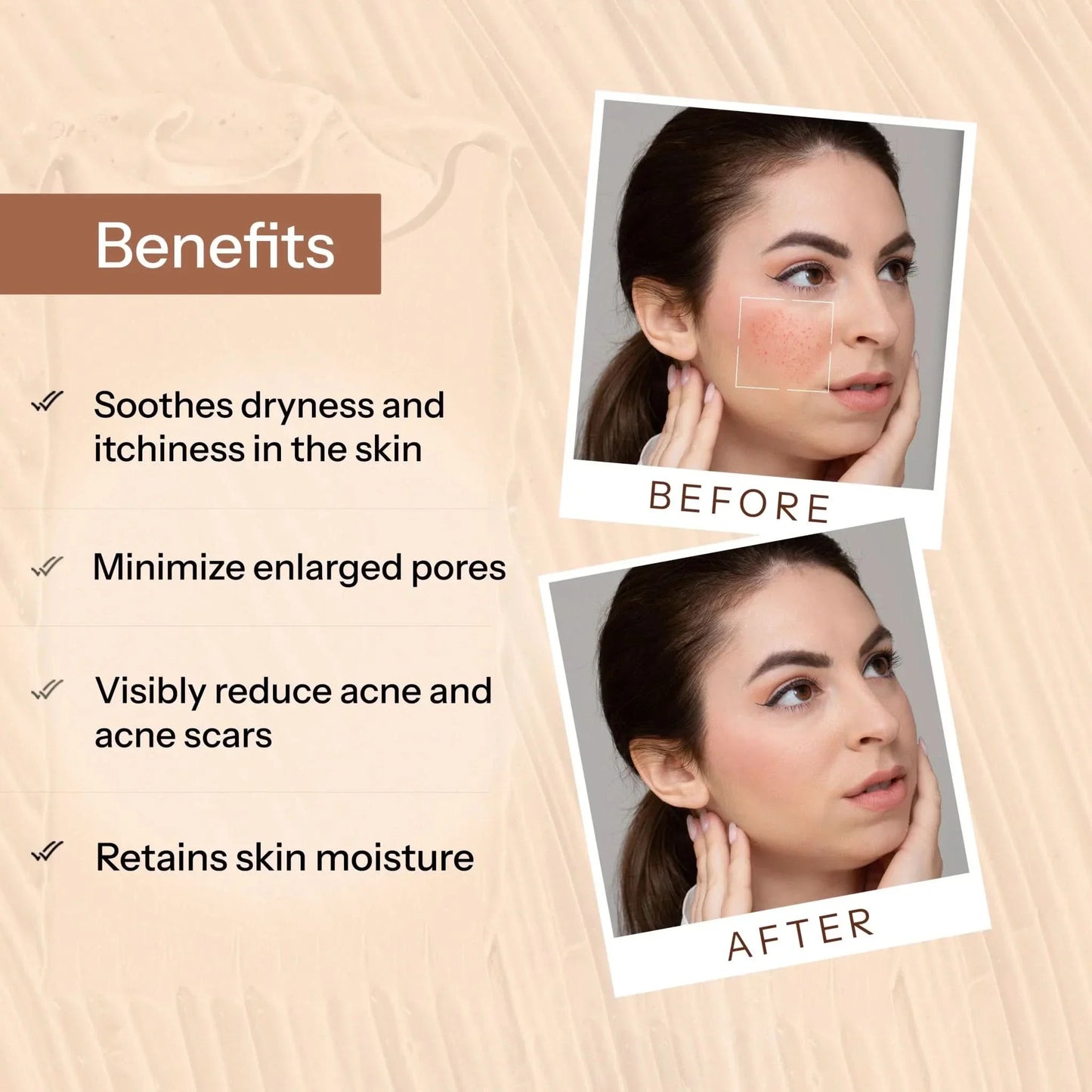 https://cdn.shopify.com/s/files/1/1857/6931/files/acne-scars-pits-removal-gel-378236.webp?v=1781082086