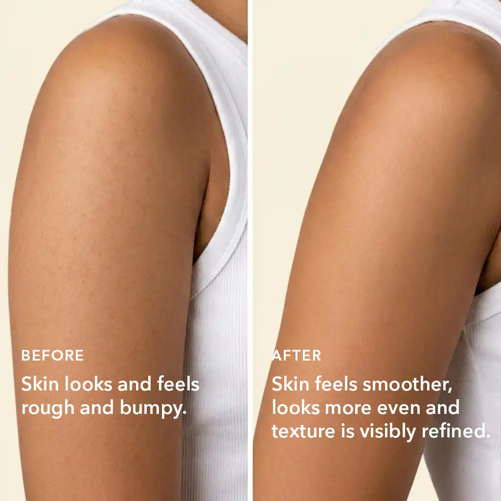 https://cdn.shopify.com/s/files/1/1857/6931/files/boofootel-bumpy-skin-before-after-results.webp?v=1778138344